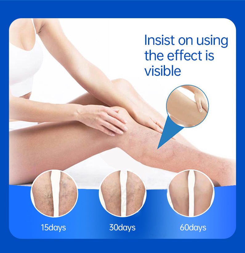 VascuRelief: Powerful Ointment for Varicose Veins and Spider Vein Pain Relief